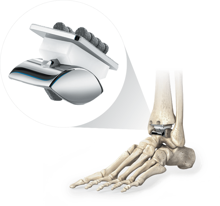 STAR Total Ankle Replacement | Stryker