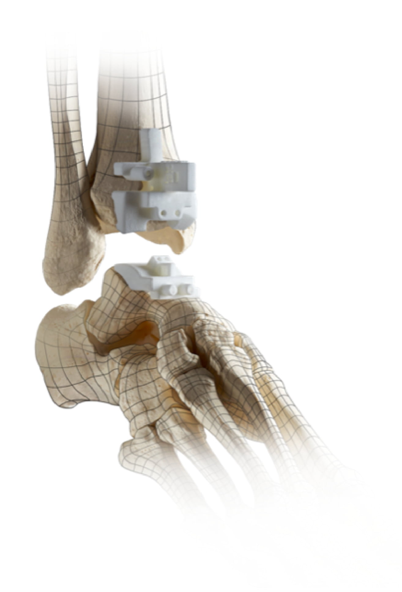 Why Total Ankle Replacement | Stryker
