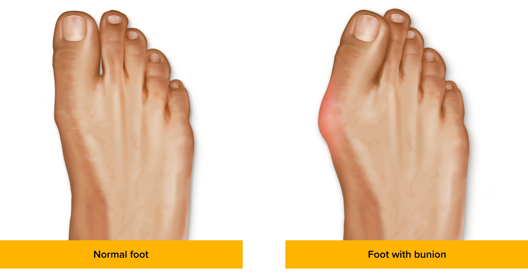 No Bunion Is Created Equal Stryker