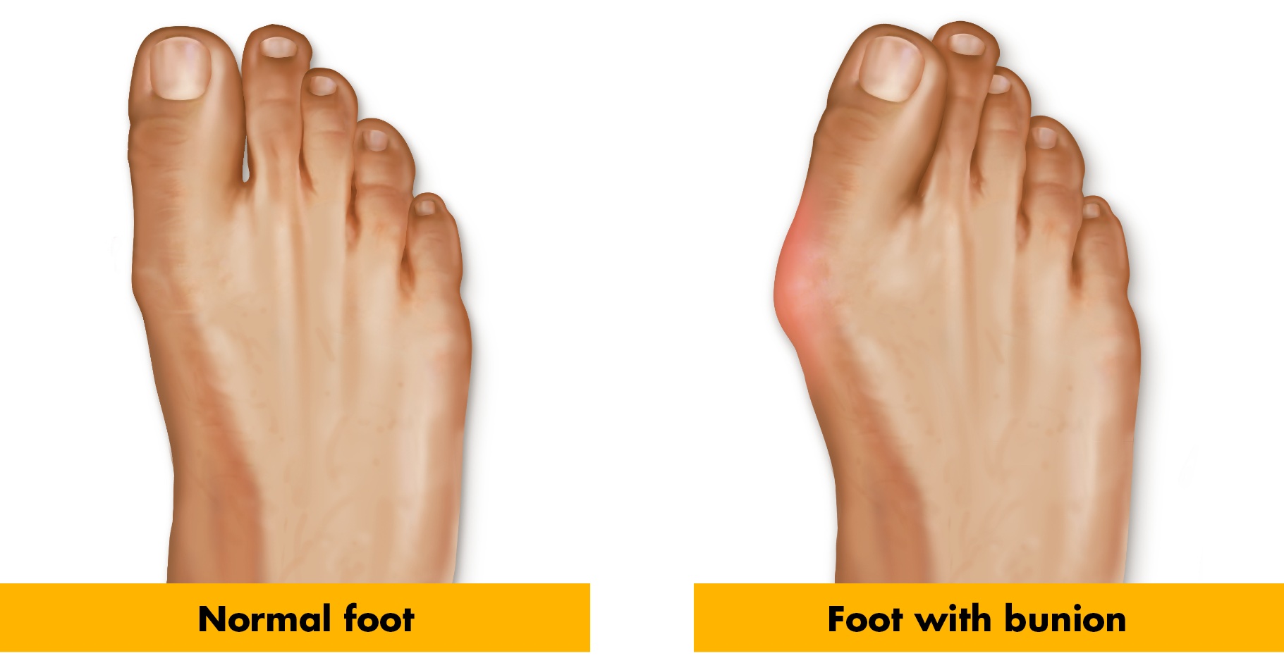 Hammer Toe vs. Bunion