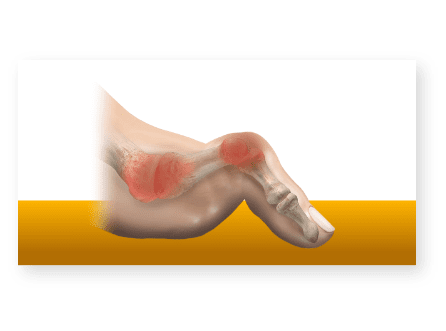 Can Hammertoes Be Dangerous?: Premier Foot and Ankle Center & Elite Upper  Extremity and Plastic Surgery: Podiatry