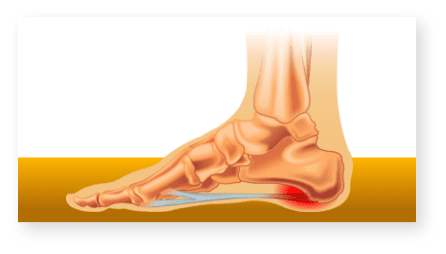 Severe plantar fasciitis on sale pain