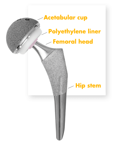 Total Hip replacement(posterior approach): Exeter femoral stem and  Tritanium acetabular component (Stryker) Surgical Technique - OrthOracle