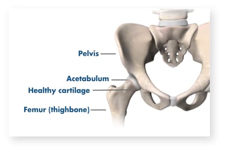 Hip Osteoarthritis - OrthoInfo - AAOS