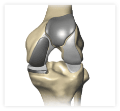 Bicompartmental knee replacement