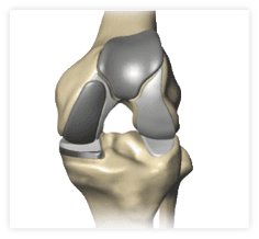 Image of Bicompartmental knee replacement implant