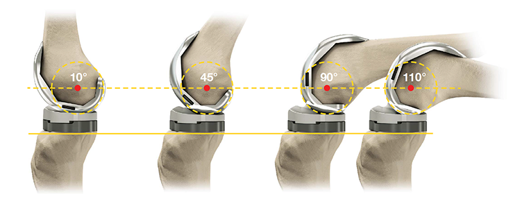 knee joint replacement devices