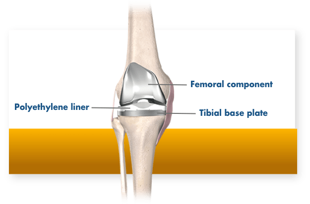 Total knee replacement implant