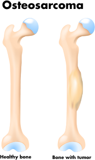 Osteosarcoma healthy bone and bone with tumor