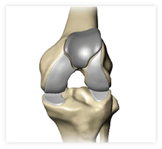Image of Patellofemoral knee replacement implant