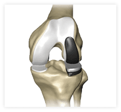 Image of Unicondylar knee replacement implant