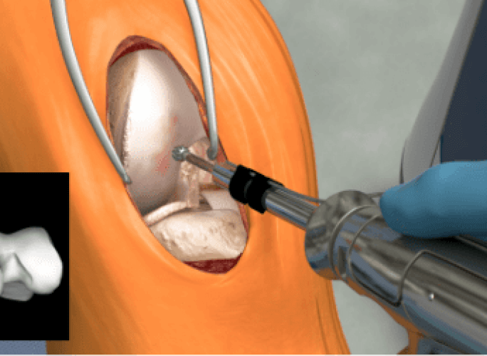 Knee joint during surgery with Mako Robotic-Arm.