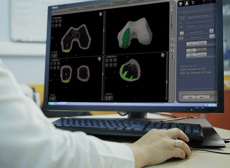 3D model of a knee joint.