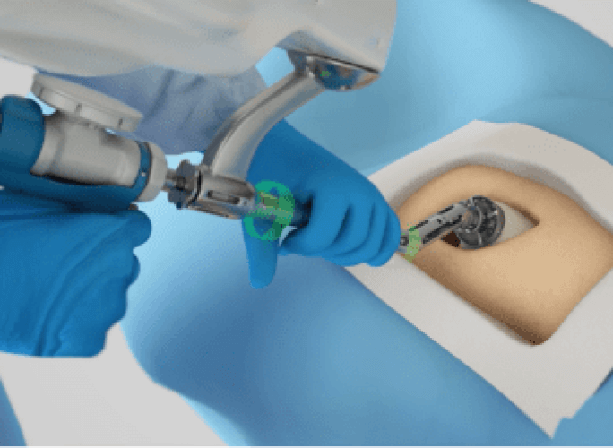 Doctor using Mako Robotic-Arm during surgery.