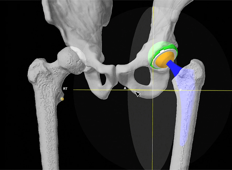 3D scan of a hip bone with hip implant.
