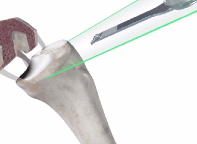 Knee bone with Mako Robotic-Arm.