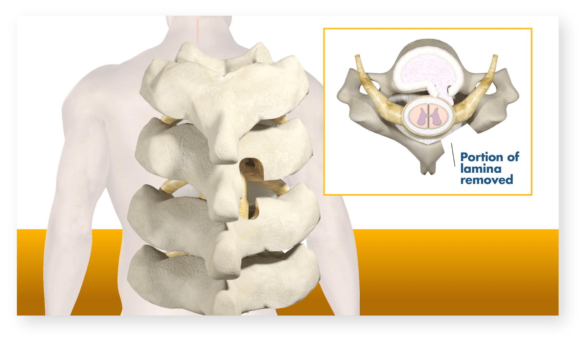 Cervical Laminectomy