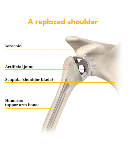 Replaced shoulder