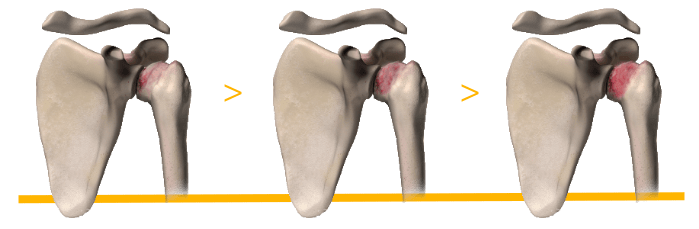 Shoulder replacement surgery - Mayo Clinic