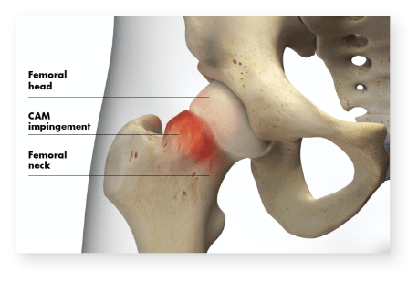 Snapping Hip - OrthoInfo - AAOS