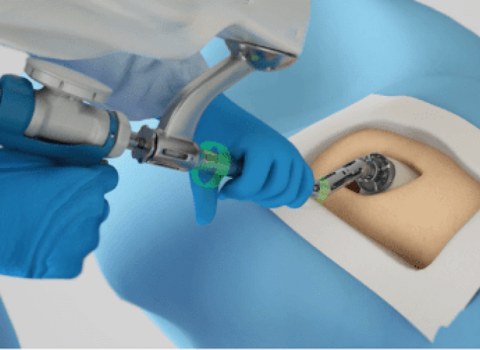 Mako total hip surgery