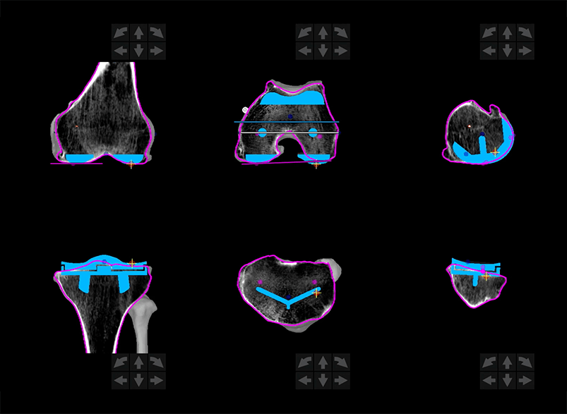 Plan based on CT scan