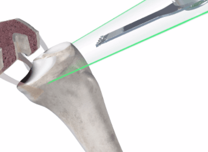 Mako total knee 